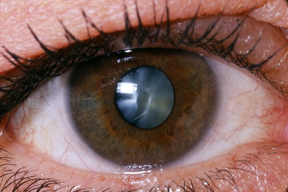 Cataract Surgery